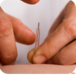 acupunture needle being inserted